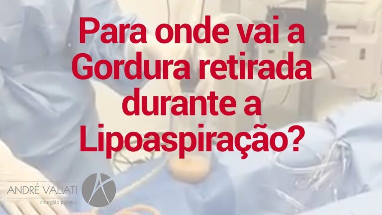 Lipoaspira&ccedil;&atilde;o em Porto: A solu&ccedil;&atilde;o eficiente para remodelar seu corpo