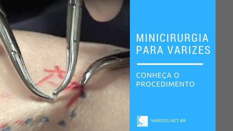 Opera&ccedil;&atilde;o Varizes: Solu&ccedil;&atilde;o Eficiente e Confi&aacute;vel