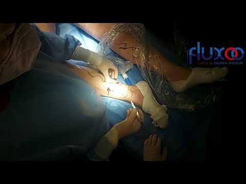Cirurgia de Varizes a Laser: Antes e Depois